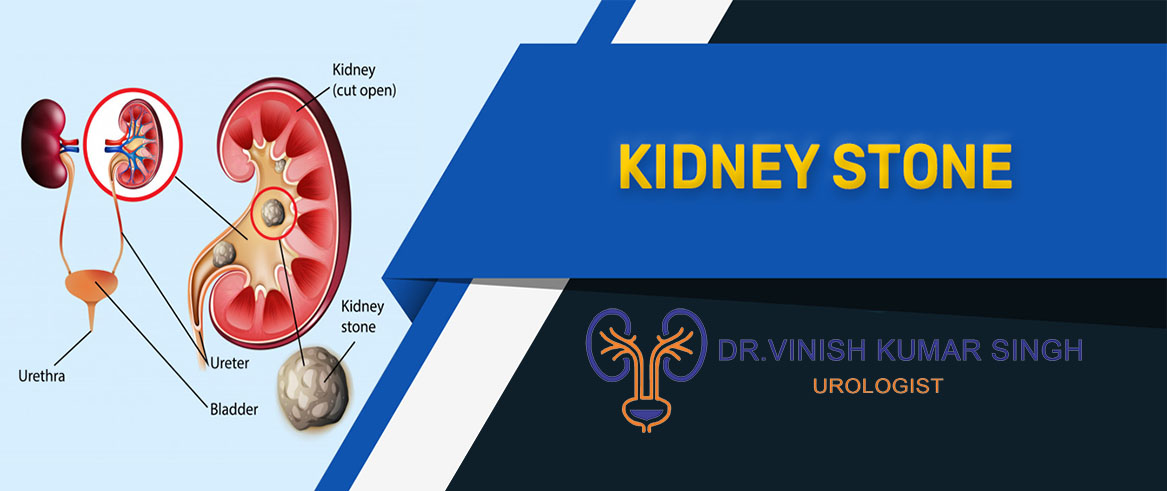 kidney stone banner